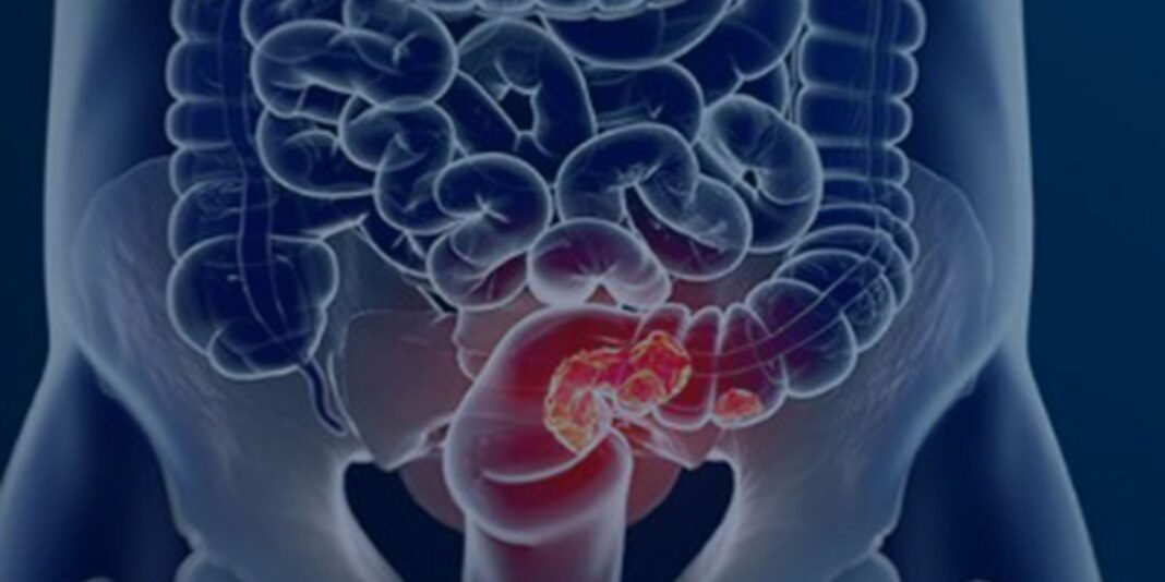 SUS pode implementar rastreamento para câncer colorretal SUS pode implementar rastreamento para câncer colorretal